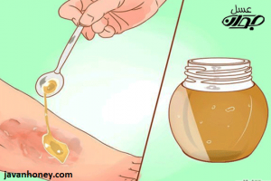 درمان زخم ها با عسل